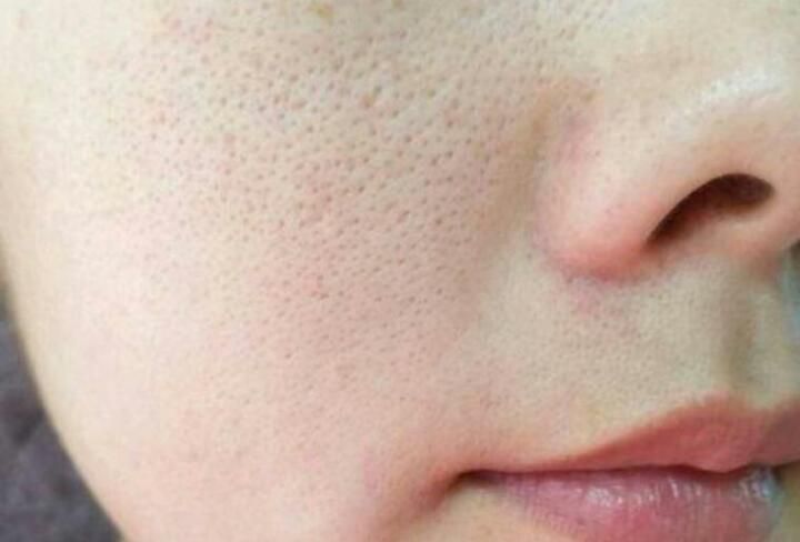 Các Cách Làm Se Khít Lỗ Chân Lông Hiệu Quả