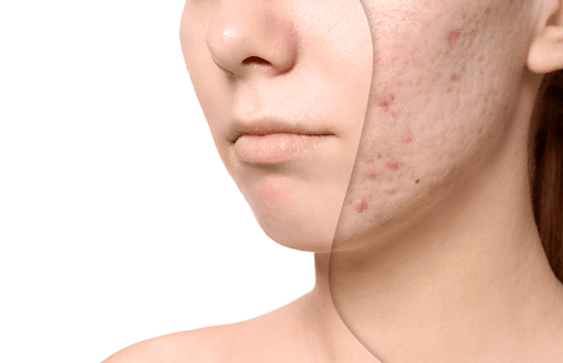 Bắn laser trị sẹo lõm: Những ưu điểm và hạn chế