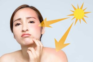 Hướng dẫn cách chăm sóc da cháy nắng