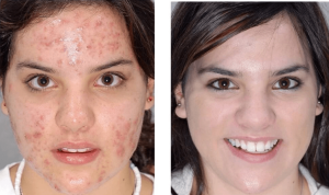 Sử Dụng Tretinoin: Bôi Trên Nền Da Khô Hay Ẩm, Cách Dùng Và Những Lưu Ý Quan Trọng