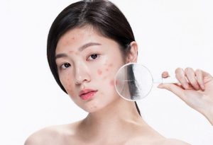 Chăm Sóc Da Ở Tuổi Dậy Thì: Những Vấn Đề Thường Gặp