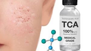 Chăm Sóc Da Sau Khi Chấm TCA: Hiểu Rõ TCA và Cách Chăm Sóc Đúng Cách