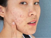 Da bị mụn có dùng được serum dưỡng trắng không? – Với Nova White 17 Ampoule, không hư tổn nào là không thể chữa lành