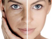 Trẻ hóa da mặt bằng laser liệu có thực sự hiệu quả?